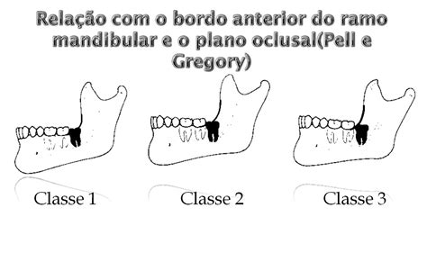 Clasificaci ó n de PellGregory sobre nivel de erupci ó n de tercer