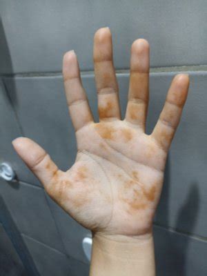 Palm Patient Erythema in Red Spots from Inflammation Stock Image
