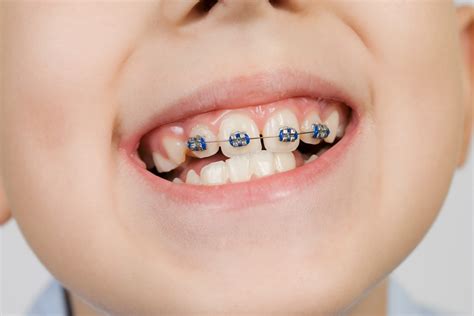 Aparelho ortodôntico pode deixar os dentes moles? Aparelho